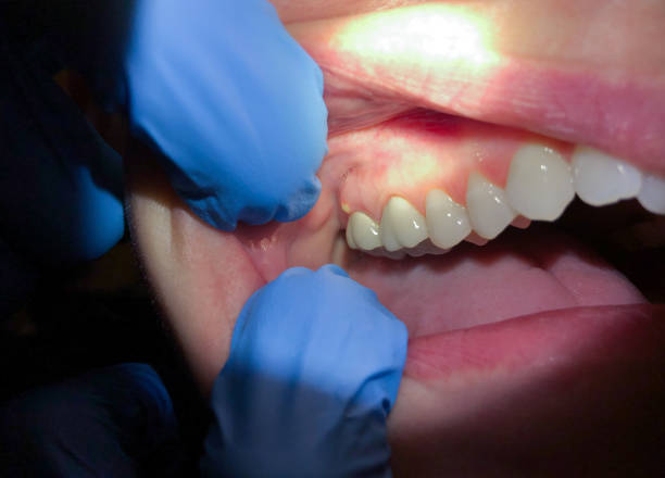 Best Emergency Denture Repair in Cinco Ranch, TX