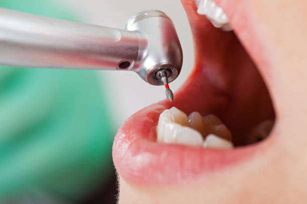 Best Urgent Care for Lost Fillings or Crowns in Cinco Ranch, TX